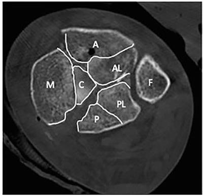 Management of Pilon Fractures—Current Concepts